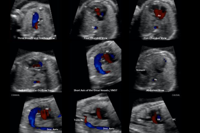 Fetal ekokardiyografi