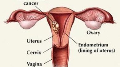 BASİT (ATİPİSİZ) ENDOMETRİAL HİPERPLAZİ TEDAVİSİ  (RAHIM DUVARI KALINLAŞMASI TEDAVİSİ)