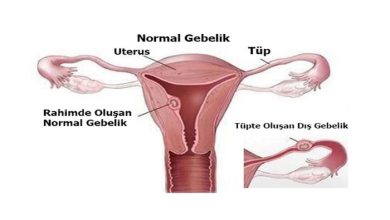 Dış Gebelik (Ektopik Gebelik)