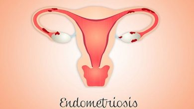 Endometriozis belirtileri nelerdir?