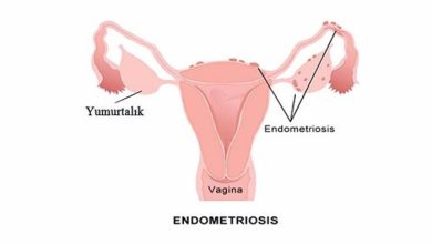 Endometriozis Nedir?