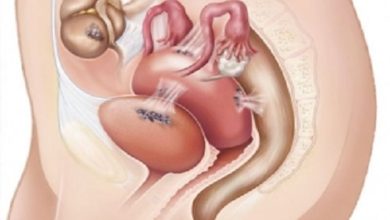 Endometriozis sıklığı nedir?