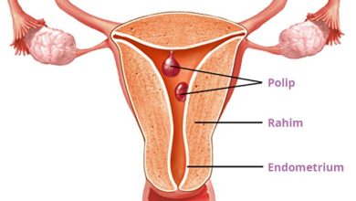 Endometriyal polipler neden önemlidir?