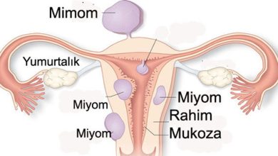 MİYOM (MYOMA UTERİ) NEDİR?