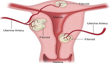 Miyomların Tanı ve Tedavisi