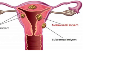 Miyomların Tanı ve Tedavisi