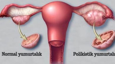 POLİKİSTİK OVER SENDROMU