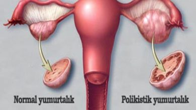 Polikistik Over Sendromu Nedenleri ve Tedavisi