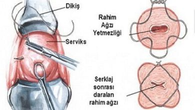 Rahim Ağzı Yetmezliği; Servikal Sörklaj