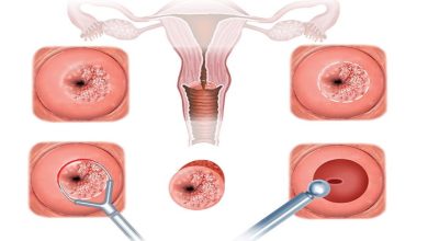 Smear testi (CVS) nedir?