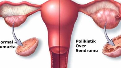 Polikistik Over Sendromu